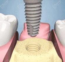 牙槽骨吸收了還可以種植牙嗎?聽九江中山口腔肖梁主任解說!