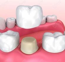 愛爾創(chuàng)和威蘭德全瓷牙有什么區(qū)別?愛爾創(chuàng)價格1200是不是真的