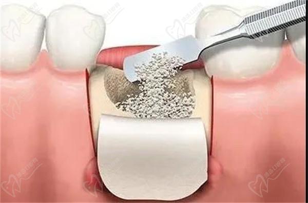 種牙過程為啥需要骨粉？什么情況才需要補骨粉？