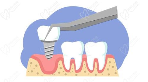 成都新橋口腔醫(yī)院劉姍韓國奧齒泰種植牙3880元起，價格不貴質量還好