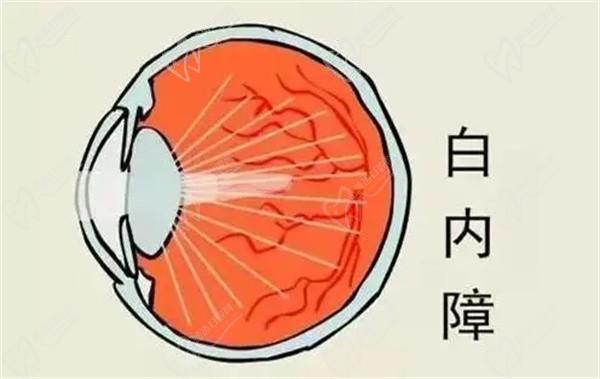 上海醫(yī)大眼科白內障手術8千-3萬起，不同品牌晶體價格有些許差異