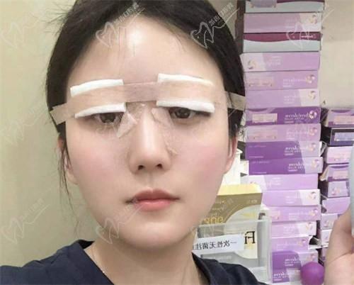 找杜園園做的8毫米寬的雙眼皮恢復(fù)圖來(lái)啦,術(shù)后30天,5個(gè)月和1年后的寬度圖片都有