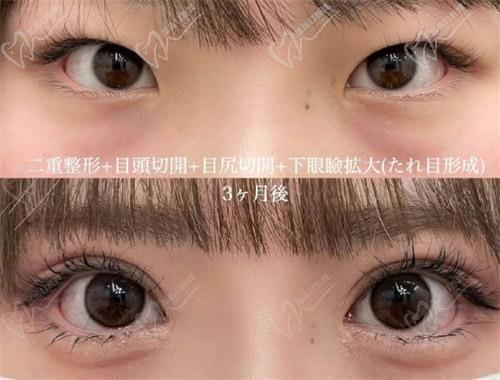 北京豐聯(lián)麗格醫(yī)療美容師麗麗修復(fù)雙眼皮怎么樣？肉條眼修復(fù)解決假寬深疤痕更隱形
