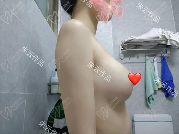 廣州朱云做胸怎么樣？是華南僅此一位做筋膜層隆胸的院長(zhǎng)名咖技術(shù)精妙口碑高
