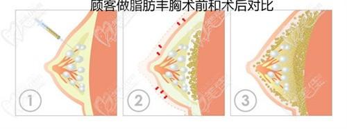 ?廣州朱云醫(yī)生擅長(zhǎng)筋膜層微痛隆胸/不良胸修復(fù)/自體脂肪復(fù)合隆胸，技術(shù)真的特別膩害！