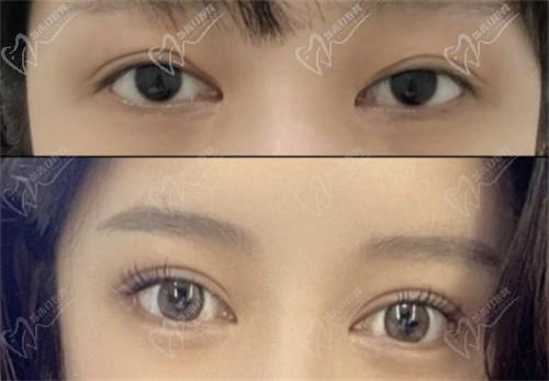 師麗麗的案例可信嗎?是不是營銷出來的?師麗麗雙眼皮修復(fù)+內(nèi)眼角修復(fù)案例