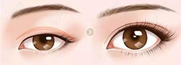 上海杜園園做眼睛失敗修復(fù)病例眾多，技術(shù)靠譜案例多，高難度眼修復(fù)難題不在話下
